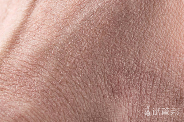 58c23298471b49f51762c16ce72f6c56.png 先天性鱼鳞病是什么原因引起的