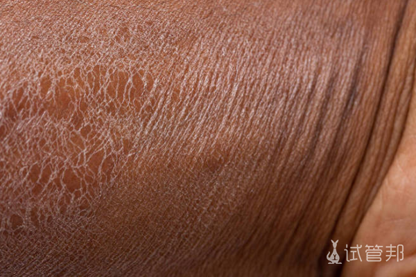 5ba7919d96b69f340c8b93a2d51cc034.png 先天性鱼鳞病是不是基因病