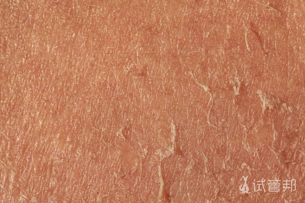 8290e30e4ba3f51041fbb46e97a1e2d6.png 先天性鱼鳞病样红皮病严重吗