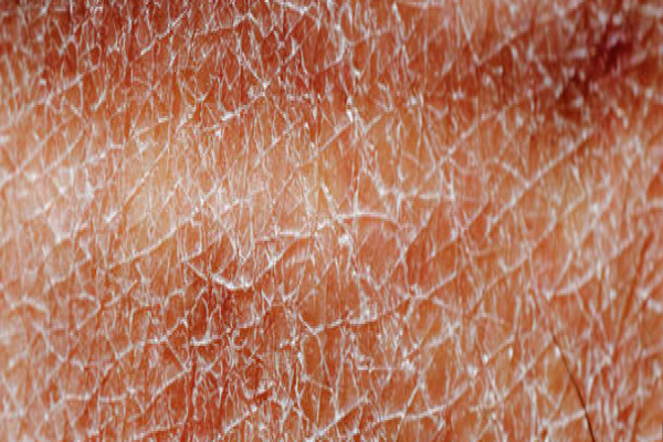 92c301ff32e5ab215938395f629ab70b.png 先天性鱼鳞病有什么症状表现