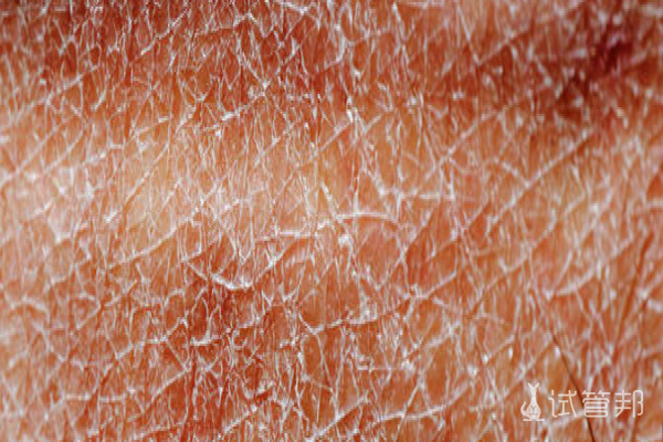 bc38a5c17a9a186bf605853af1b31102.png 先天性鱼鳞病怎么诊断出的