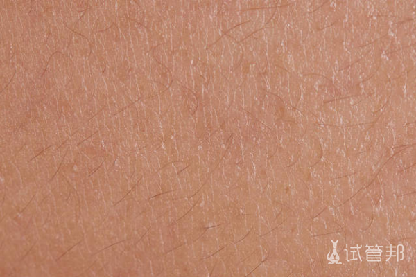 cdc28e6a30c5a6d1edf4f77a920ef9ba.png 先天性鱼鳞病能干预吗