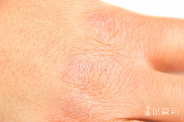 f37122a4684e665125177dafcc545f70.png 先天性鱼鳞病会遗传给下一代吗