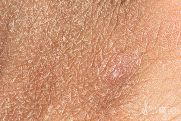 f43b4d87da95f543d849cc6914e9846b.png 鱼鳞病什么原因导致的