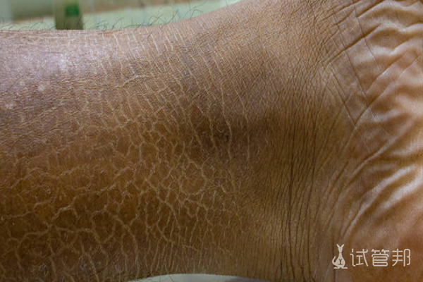 f9bfac8daf478394802efda1619f5be1.png 鱼鳞病治疗后能恢复到正常人皮肤吗