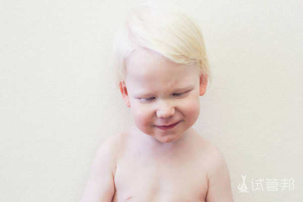 2b81b285e4911185a53e06689f049ceb.png 白化病指的是什么