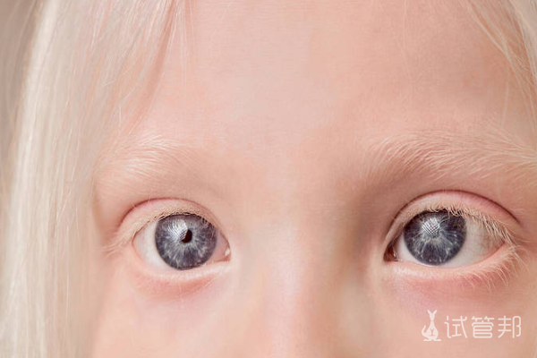 34bee7c7909d3efba6c677a7603a5c30.png 白化病症状表现有哪些