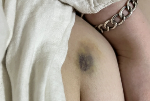 3fd2b7dbd848f6c862f102c3dd6a11a4.png 试管取卵后腹水第五天这个日子是真难熬呀