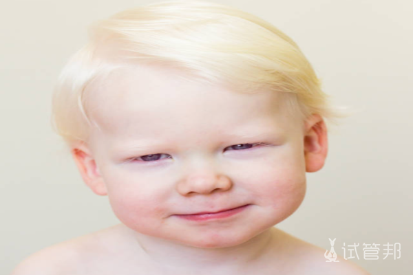 49a77e8b8b71651ab7dacddb1c2da111.png 白化病是怎么回事