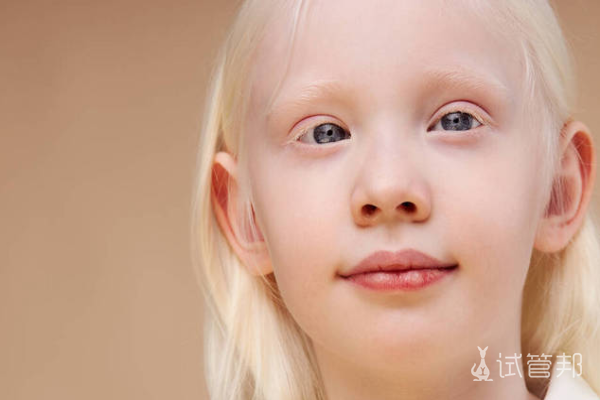 5efaad77437e3d4ed2fc6f8f25872c5d.png 白化病会遗传吗