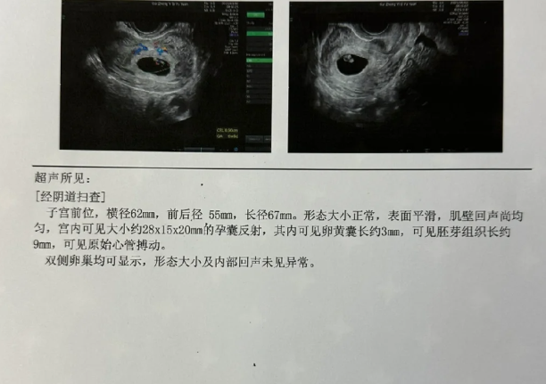 以42高龄试管一促二移上岸