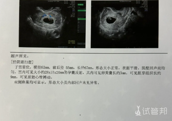 以42高龄试管一促二移上岸