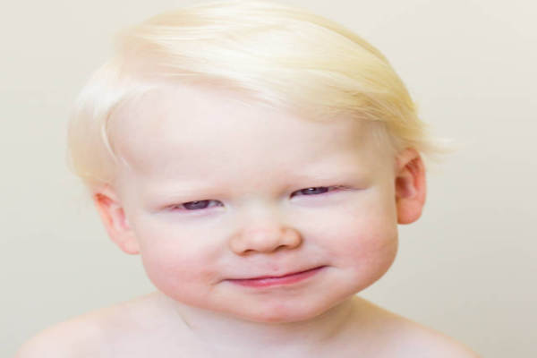 ce8145da4c5d7071f4a9a2d8bc70cdf7.png 白化病要紧吗