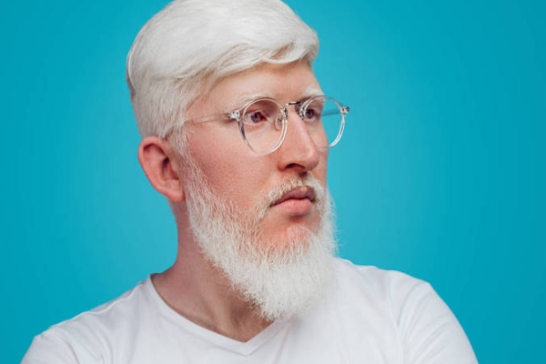 ddf36c32d30a88136cae297a74258146.png 白化病会不会遗传给下一代