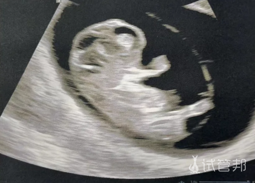 94fadbcfd4463f563f679bb3aa03b862.png 试管婴儿毕业174天的等待和努力值了