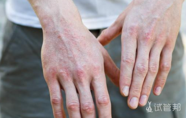 58ec9292da4a1db3534f66624b9c3670.png 红斑狼疮能不能过夫妻生活