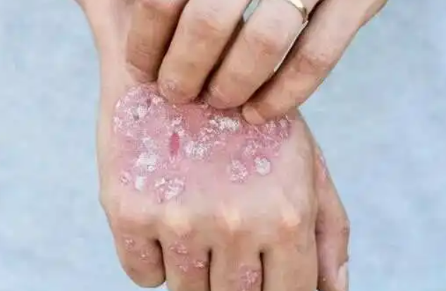 78c34941dfac867531f4cb34f43e18b4.png 红斑狼疮图片和症状图片对照