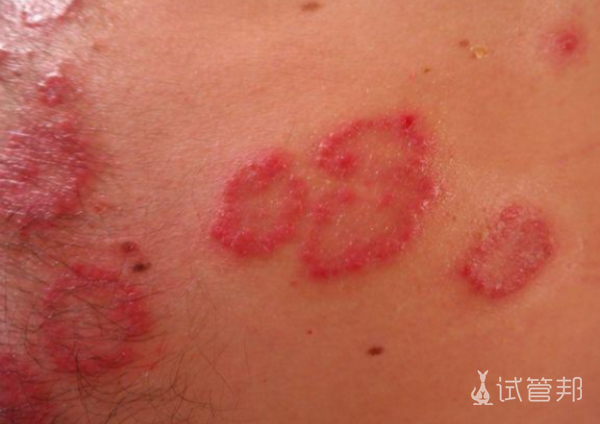 21e9216344aae2cfb8559db019efc07e.png 红斑狼疮能生孩子吗