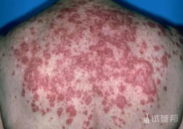 3847e48681fef2d1d498184f16d8c078.png 红斑狼疮能治愈吗