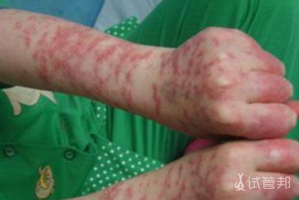 685e8017a2187160d8fb1b659b1ed440.png 系统性红斑狼疮诊断标准是什么