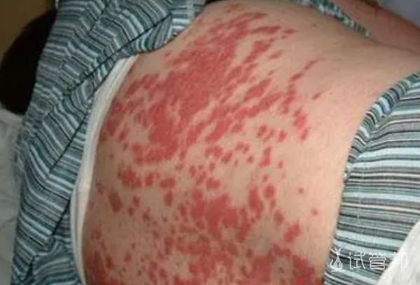 a050327ae8b4f68ee73b20b6fc62da72.png 系统性红斑狼疮检查项目有哪些