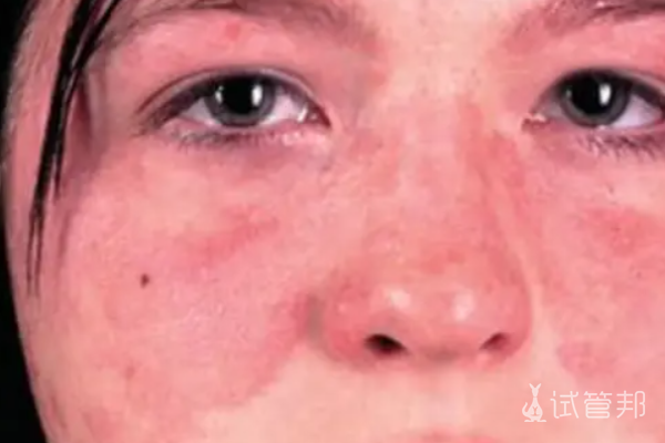 b258c0fdb4a5d06aba98daa3a88d4d57.png 红斑狼疮是怎么引起的