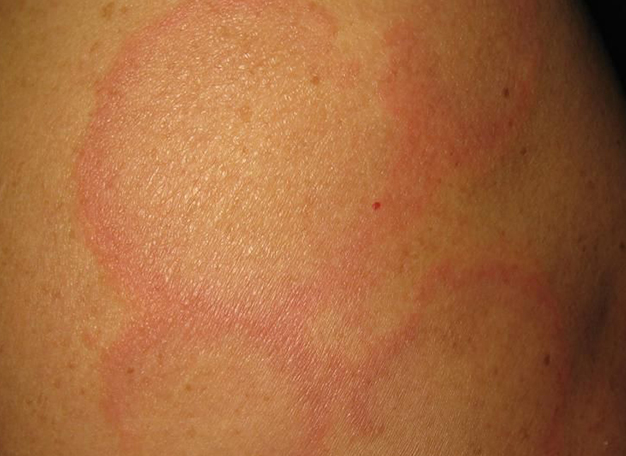 ff95c42e792975f1d414f3d6b063fb7e.png 红斑狼疮能活多久