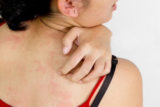 16e42414bc1ecf7e28dad8579e667522.png 系统性红斑狼疮会导致电解质紊乱吗