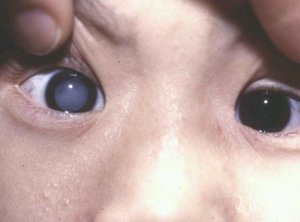 301fc6434f78d2d3e9a0b5b25fd14d11.png 先天性白内障能治好吗