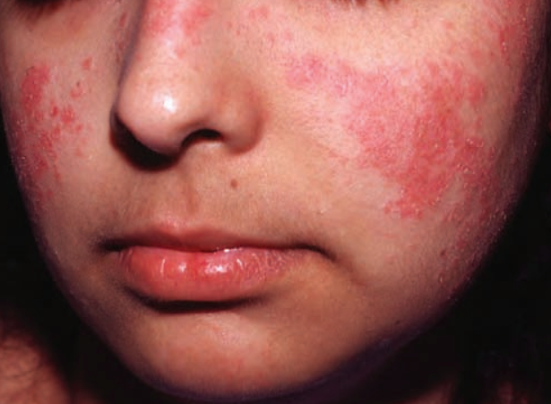 ae8ae337ef753ba3d95d5979b9fa10e0.png 系统性红斑狼疮的症状有哪些