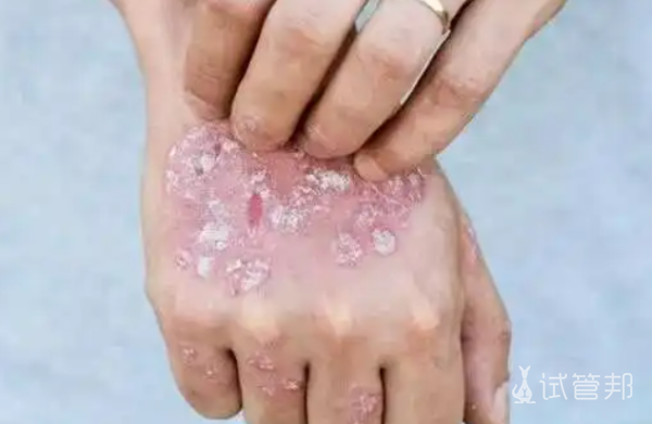 dfbd013ea4807111b9ebbd2cda14f420.png 系统性红斑狼疮可以治愈吗