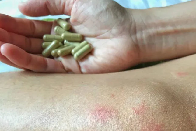 f64d2acd9c557bdff9e50adc20e3239a.png 系统性红斑狼疮会遗传给孩子吗