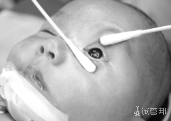 100d9351ebe20cbbbd88bdb558bbb47b.png 先天性白内障症状有哪些