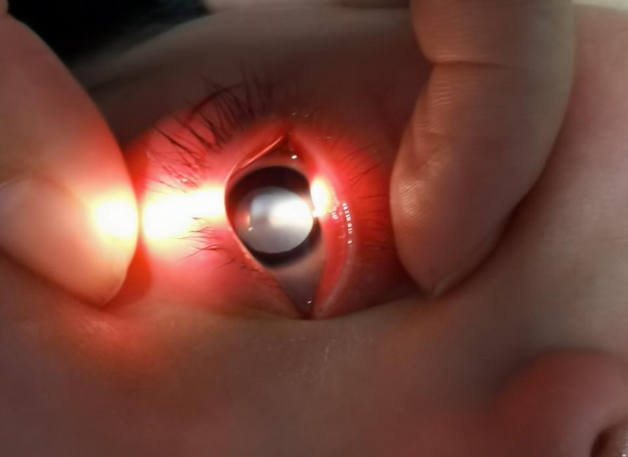 2ea01af03279b4baf4b8ee503a593d1c.png 先天性白内障能自愈吗