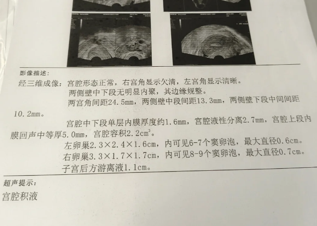 2促5移第一个周期因宫腔积液取消移植