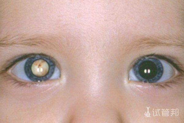b417f0af5f47ad0e6d659aa19867e949.png 先天性白内障会继续发展吗