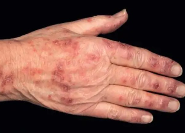 9ae6eb174bc1b47fa941ed00a7fd274b.png 系统性红斑狼疮做试管婴儿项目价格全介绍