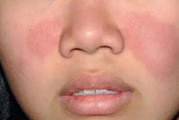 af66297b98d5ea1860e7a5bc409d8b0e.png 系统性红斑狼疮做试管婴儿的价格会受哪些因素影响?