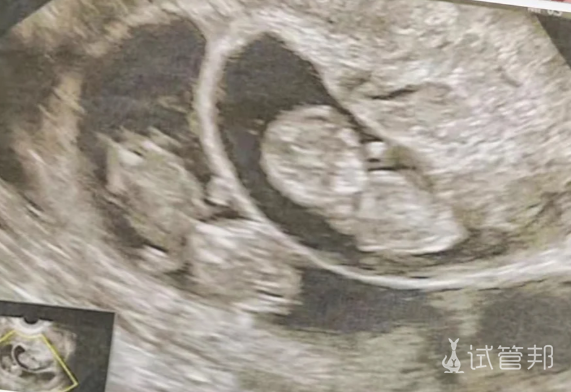 8a71db988c23a5f20a95dd4131113fff.png 生双胞胎的妈妈有哪些共同点