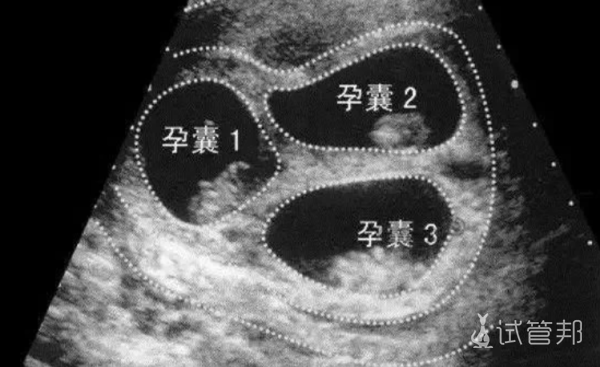 36c424f893fbccb9e3a7ac45a9798069.png 庆幸没有选择减胎三胞胎宝宝都很健康