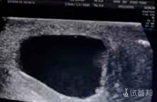 c8992304dc937cc4b0117b9dda714115.png 真没想到肺结核还会引起睾丸结核