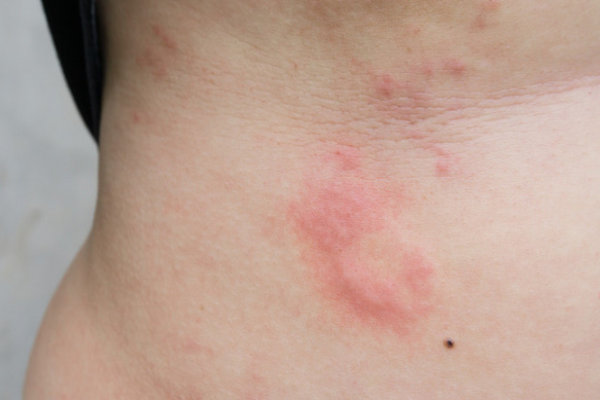 2179342783569b3701f673bc9bf45327.png 荨麻疹能治愈吗