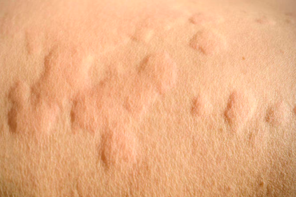 237ca3e9f45a6775da54f86038572478.png 荨麻疹免疫力是低还是高