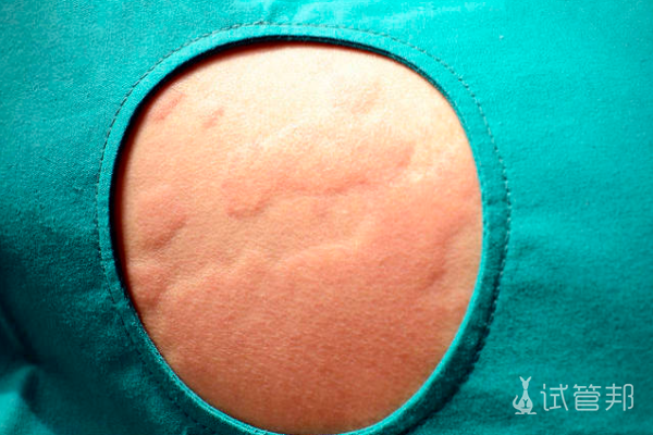 31f806435628cb2909457f1432e5905d.png 荨麻疹有必要去医院吗