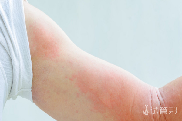 4bda601751f7376e3c08b558612050e2.png 荨麻疹对生命有影响吗