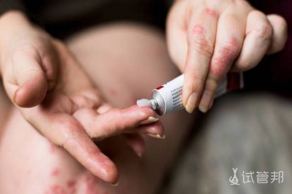 61d0ec0f9e97b29a95e33340f32e4ccb.png 荨麻疹用什么药膏效果好