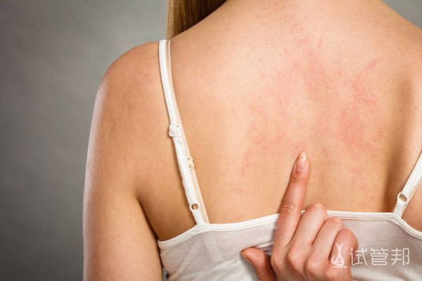 9bdf70b4b1f81ff4ce4ef92b4249208f.png 荨麻疹如何能根治