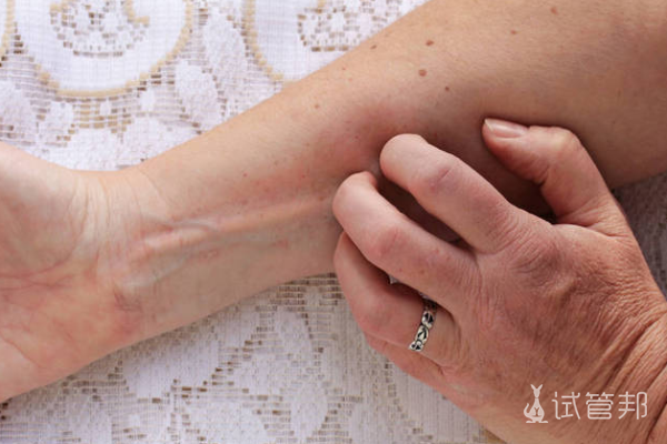 a7b34f6ec62f25ac80bf704f6f4c49d7.png 过敏性荨麻疹一般多久消退