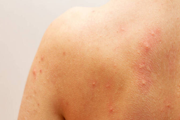 c34359dc50e4a7f231be59cdc00e5611.png 荨麻疹严重吗