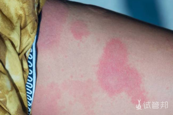 d19d0ef73b71b5da390e086245cda56d.png 荨麻疹表现有哪些